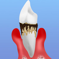 【ステージ3】重度の歯周病
